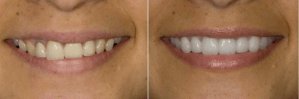 conditions that porcelain veneers can correct